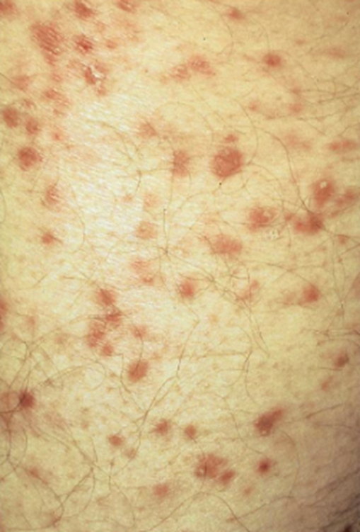 Pityriasis lichenoides - British Association of Dermatologists