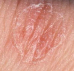 When a tiny patch of scaly skin is the first sign of ...