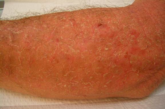 Album:Eczema 2.jpg