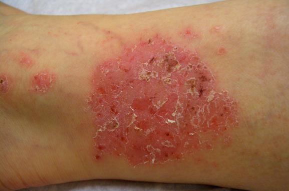 Album:Eczema 1.jpg